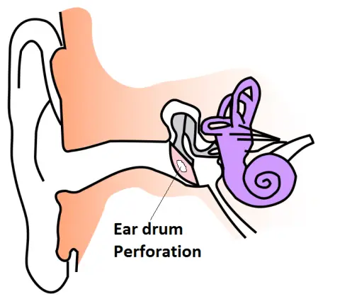 ear drum perforation