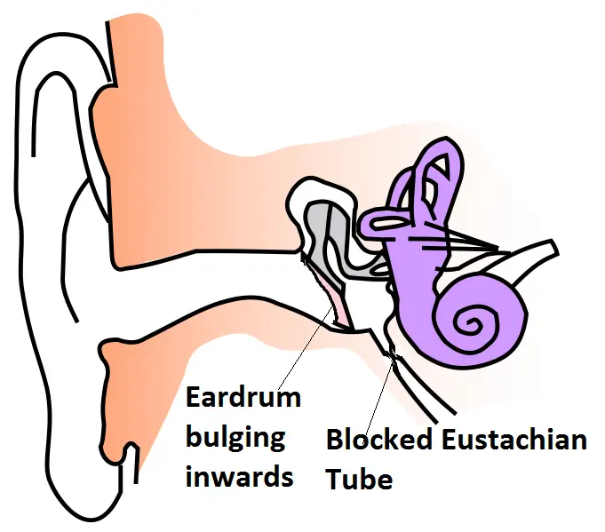 middle ear barotrauma