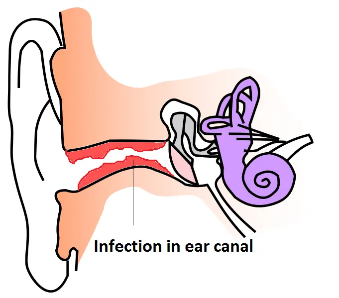 outer ear infection